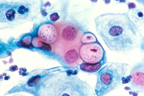 photo de chlamydia 